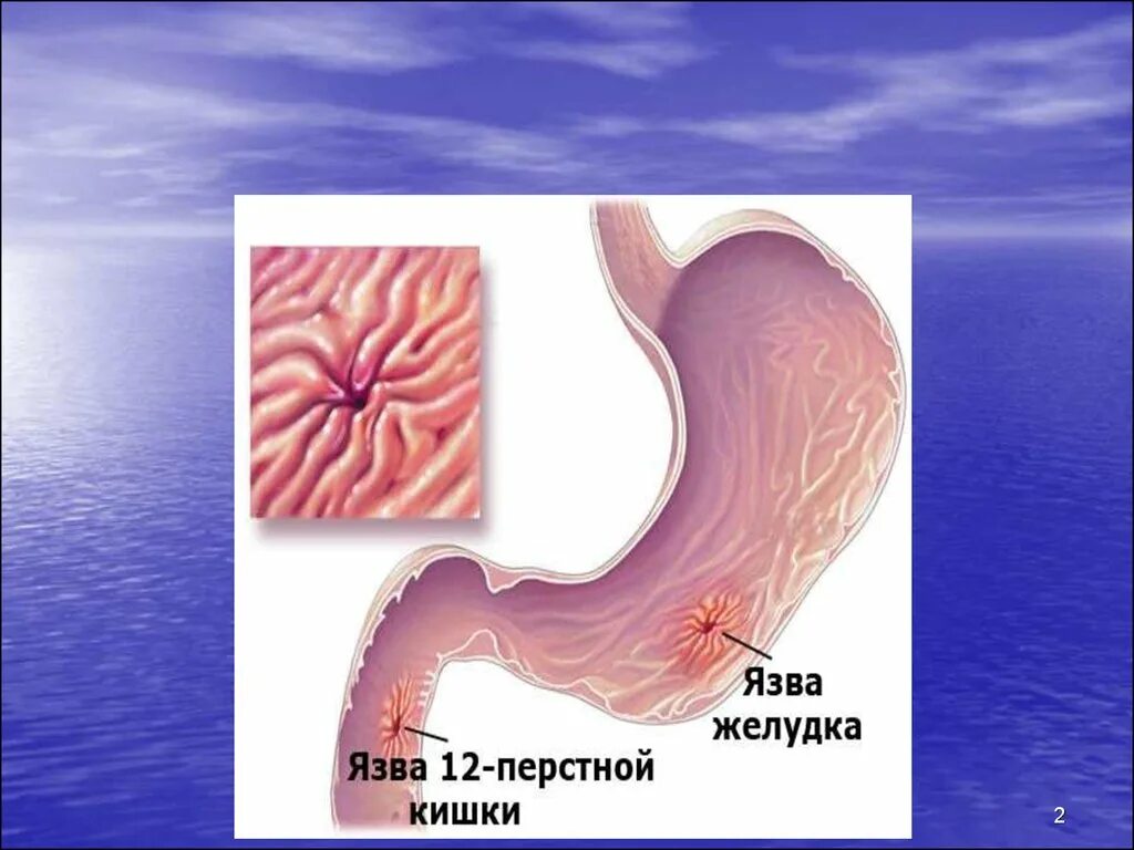 Язва желудка и 12 перстной кишки. Язвенная болезнь желудка и 12 перстной кишки у детей. Язва желудка и 12 перстной кишки терапия. Язва 12перстной кишки возникновение. Осложнения желудка 12 перстной кишки