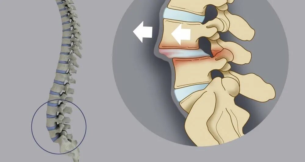 Включи l 3. Спондилолистез l3. Ретролистез l2 l3 l4. Ретролистез l4 l5 позвонков что это. Ретролистез позвонков l2-l4.