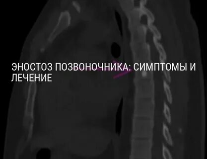 Th11 позвонка