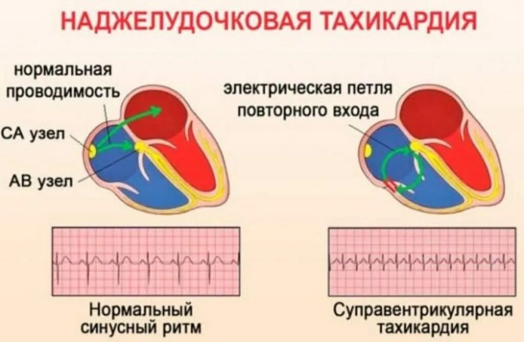 Сильное сердцебиение температура. Наджелудочковые пароксизмальные тахикардии ЭКГ. Суправентрикулярная тахиаритмия на ЭКГ. Наджелудочковая тахикардия. Суправентрикулярная наджелудочковая тахикардия.