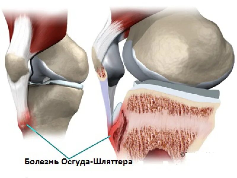 Болезнь осгут шляттера. Болезнь шляттера коленного сустава. болезнь коленного сустава осгуда-шлаттера. осгуд шляттера болезнь коленного сустава. шлятхер болезнь колена.