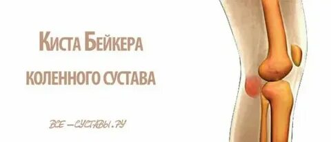 Лечение кисты под микроскопом