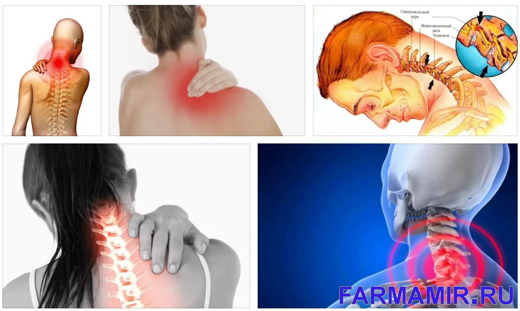 Остеохондроз это кратко. Позоночникщейный отдел. Поражение шейного отдела позвоночника. Радикулопатия с2-с3 корешков. Поражение шейного отдела позвоночника.