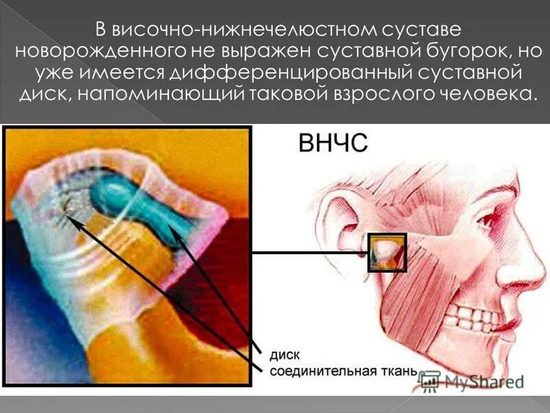 Область внчс. Дисфункция височно верхнечелюстного сустава. Травматический артрит ВНЧС. Челюстью(дисфункция ВНЧС). Заболевания височно-нижнечелюстного сустава и жевательных мышц.