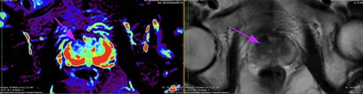 Аденома предстательной железы мрт. Мрт простаты динамическое контрастирование. Аденома простаты мрт