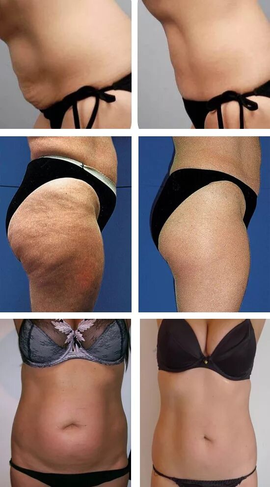 Уз кавитация аппарат. Вакуумная липосакция живота (2-6 зон). Кавитация ультразвуковая липосакция. Вакуумная уз кавитация. Кавитация рф лифтинг вакуумный.