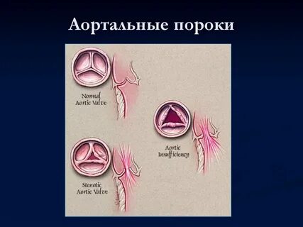Аортальные пороки рекомендации