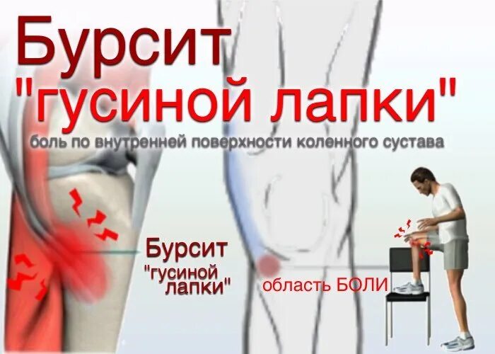 Как лечить гусиную лапку