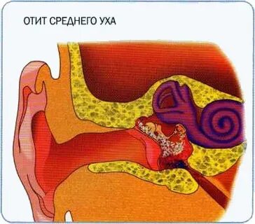 Отит какие