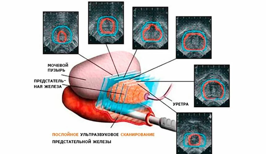 УЗИ предстательной железы (с допплерографией сосудов). Трансректальное УЗИ предстательной железы. УЗИ анатомия предстательной железы трансректально. Трансректальное трузи подготовка. Трузи предстательной железы как делают