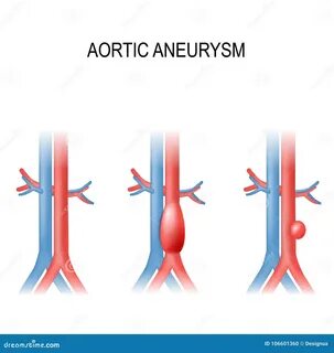 Abdominal aortic aneurysm