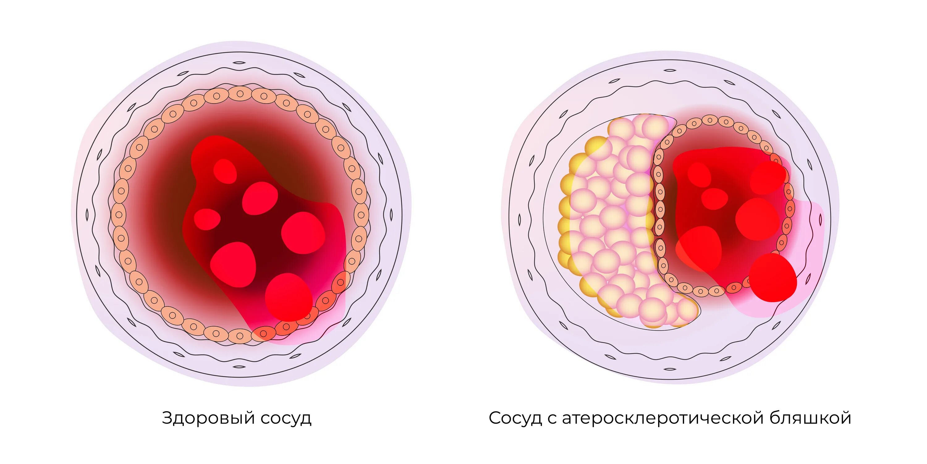 Как проверить сосуды на тромбы и холестериновые