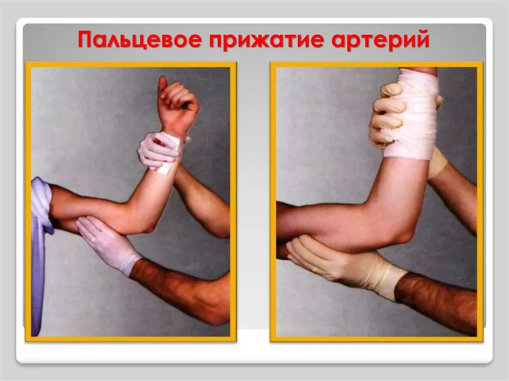 Пальцевое прижатие при кровотечении. Прижатие плечевой артерии. пальцевое прижатие артерий. метод пальцевого прижатия плечевой артерии. выполнить пальцевое прижатие бедренной артерии.