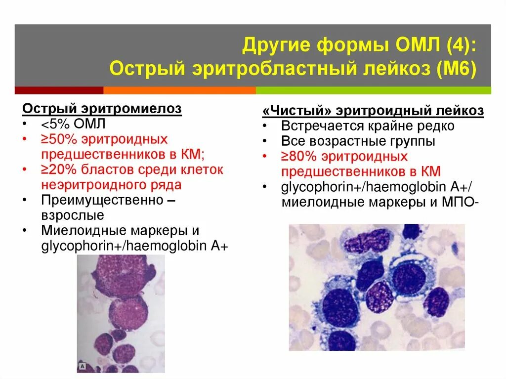 Острый эритромиелобластный лейкоз. Острый миелобластный лейкоз картина костного мозга. Острый эритролейкоз картина крови. Эритробластный лейкоз картина крови.