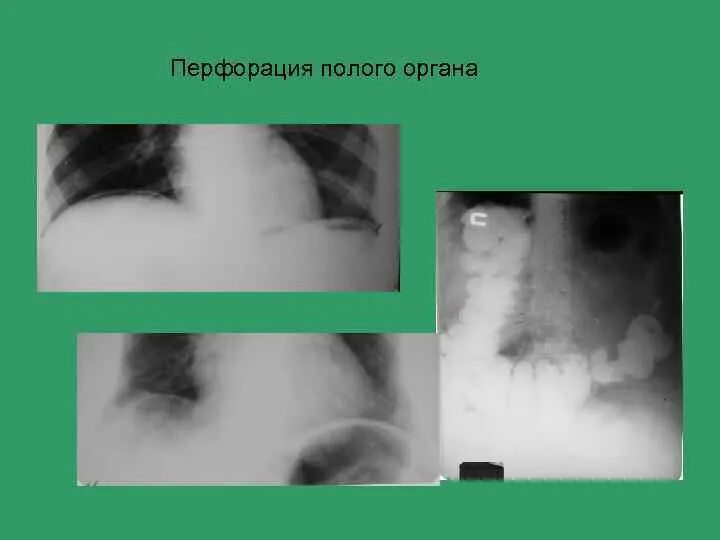 Рентген признаки перфорации полого органа. Дифференциальный диагноз перитонита. Разлитой перитонит дифференциальная диагностика. Диагностика полого органа. Методы обследования брюшной полости.