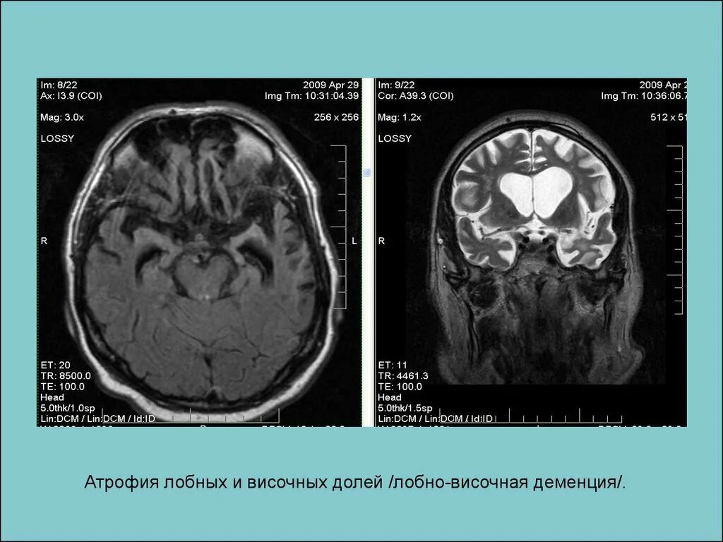 Субатрофия головного мозга что это. Атрофические изменения головного мозга кт. Лобно-височная деменция мрт. Атрофия головного мозга мрт.