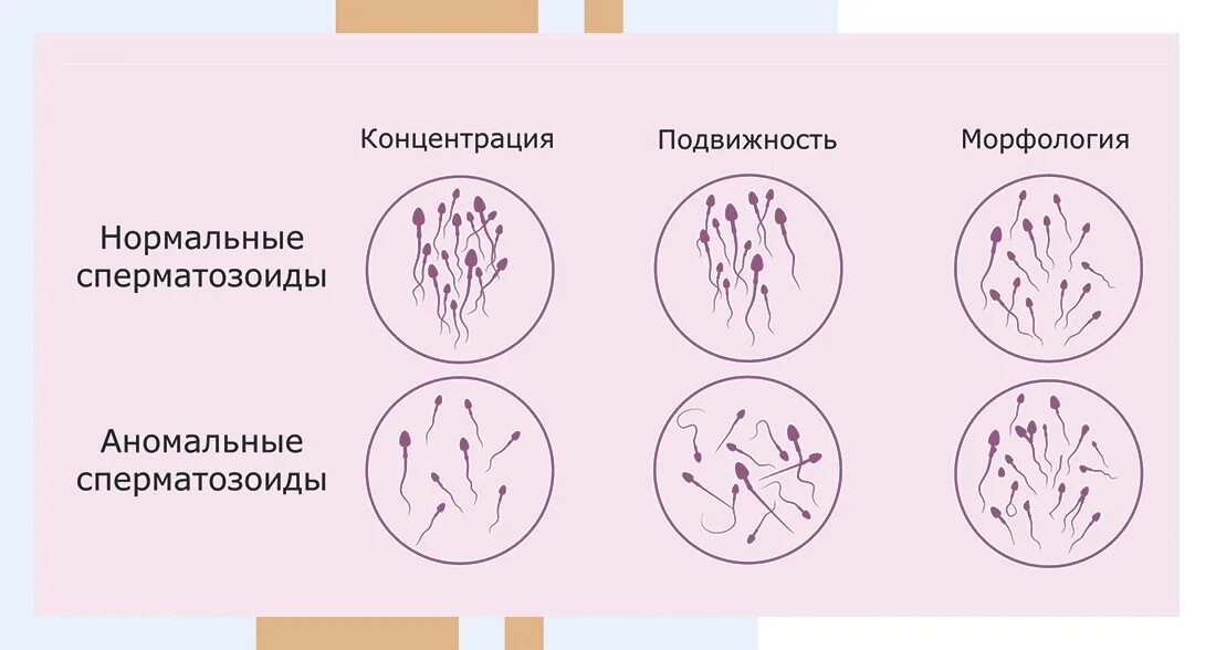 Нормальные и аномальные спермии. Спермограмма с аномальными сперматозоидами. Аномальные сперматозоиды. Нормальные сперматозоиды. Какой должен быть цвет половых