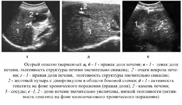 Гепатит желчный пузырь. УЗИ брюшной полости при гепатите. Хронический гепатит УЗИ протокол. Острый гепатит УЗИ картина. УЗИ картина гепатита печени.