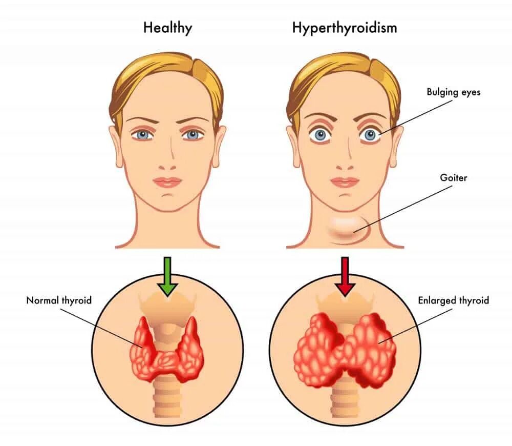 При гипертиреозе можно принимать. Гипертиреоз щитовидной железы. Болезнь щитовидной железы гипертиреоз. Тиреотоксикоз гиперфункция щитовидной железы. Гипертиреоз болезнь щитовидки гипотиреоз.