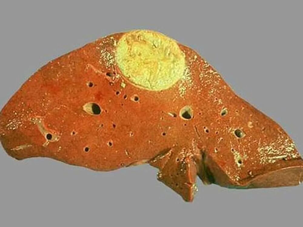 Аскариды легочные гельминты. Глисты в легких на рентгеновском снимке. Эхинококкоз и альвеококкоз печени. Глисты в легких на рентгеновском снимке. Паразиты в легких рентген.