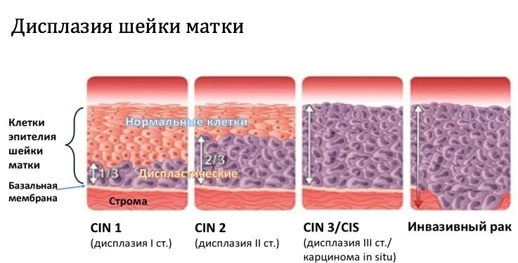 Дисплазия 1 степени шейки матки что это