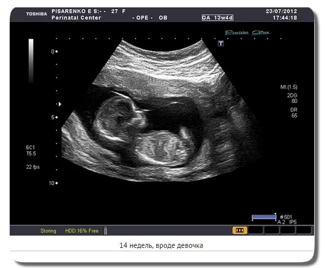 Малыш на 14 неделе. УЗИ 14 недель беременности. УЗИ плода на 14 неделе беременности. УЗИ 15 недель беременности пол. 14 Недель беременности фото плода на УЗИ.