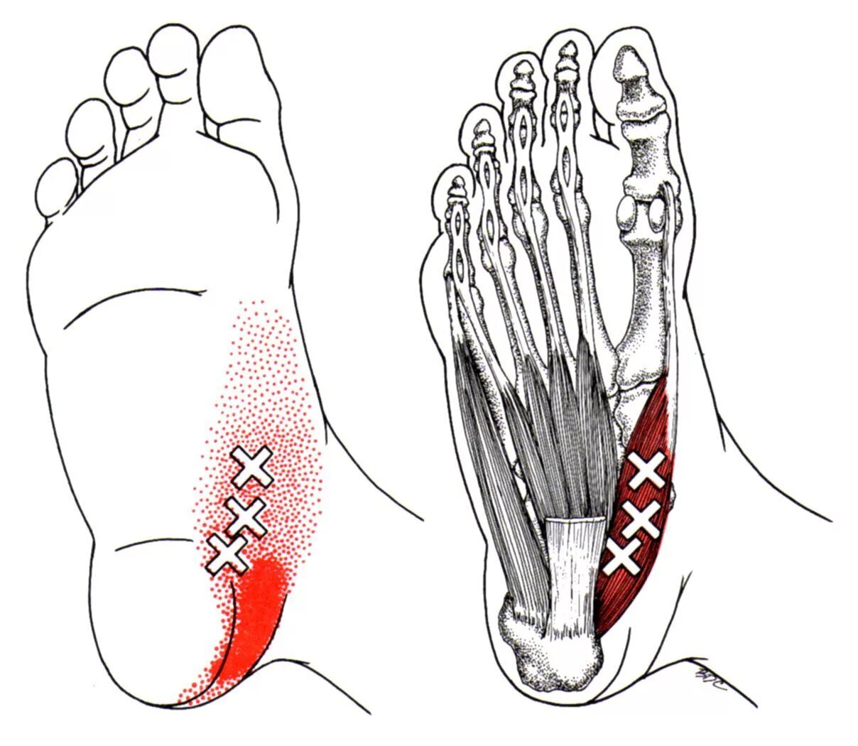 Foot muscle. Триггерные точки мышц стопы. Abductor Hallucis мышца. Триггерные точки голеностопного сустава. Триггерные точки боль в стопе.