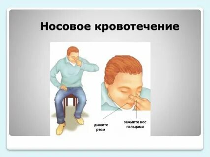 Носовые кровотечения у пожилых