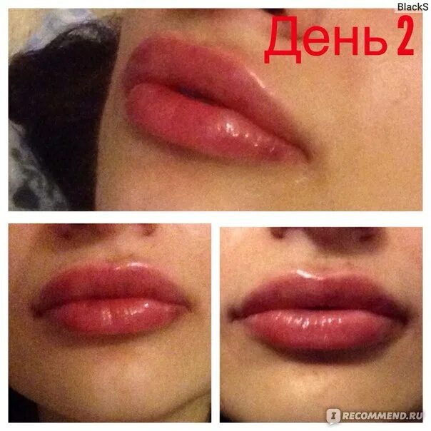 Как долго проходят губы после увеличения. Губы на второй день после увеличения. отек губ после увеличения губ.