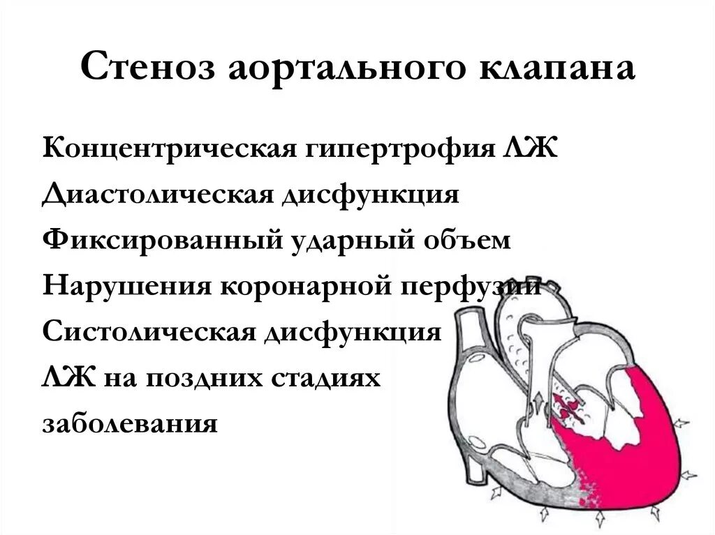 Митральный аортальный стеноз. Стеноз клапана аорты гемодинамика. Стеноз устья аорты гемодинамика. Стеноз устья аорты гемодинамика схема. Стеноз устья аорты и недостаточность аортального клапана.