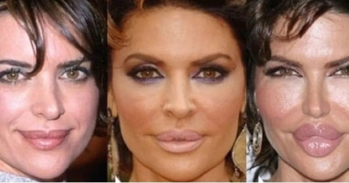 кэти топурия до пластики. джослин вильденштейн 2023. донателла версаче неудачная пластика. до и после пластической операции. дженис дикинсон ботокс.