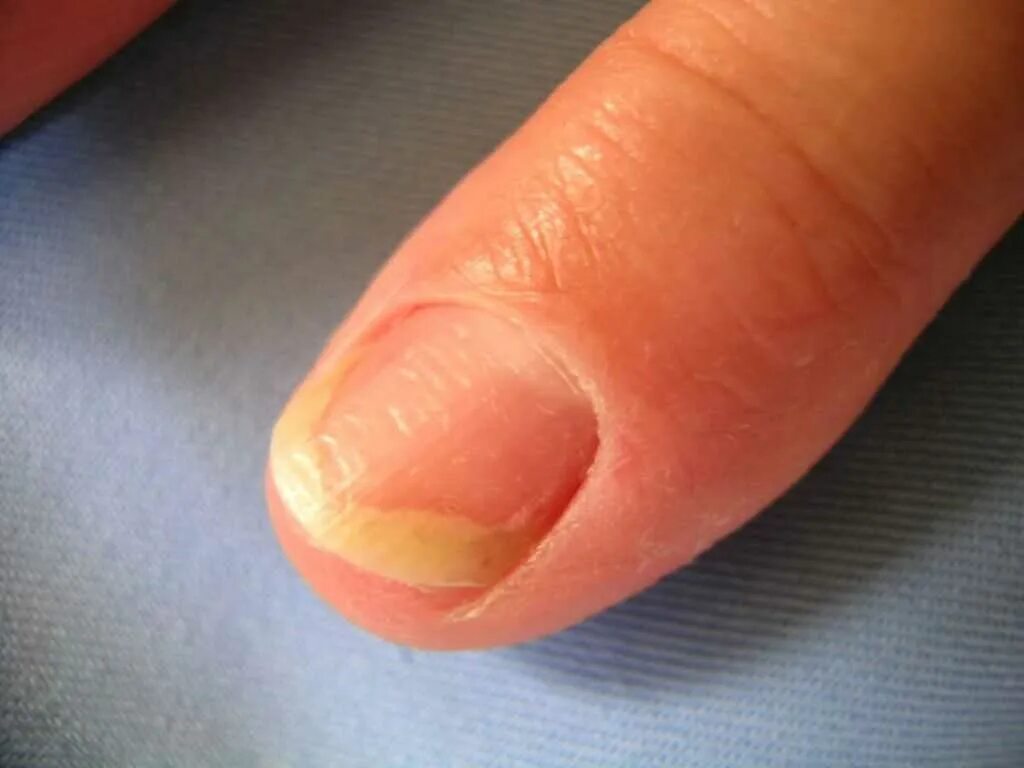 Онихолизис ногтевого ложа. Механический онихолизис. Онихолизис ногтевой пластины. Латеральный онихолизис. Полулунном онихолизис.