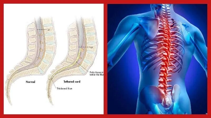 Тетеринг синдром спинного мозга. Синдром фиксированного спинного мозга у детей. Фиксация терминальной нити спинного мозга. Фиксированный спинной мозг.