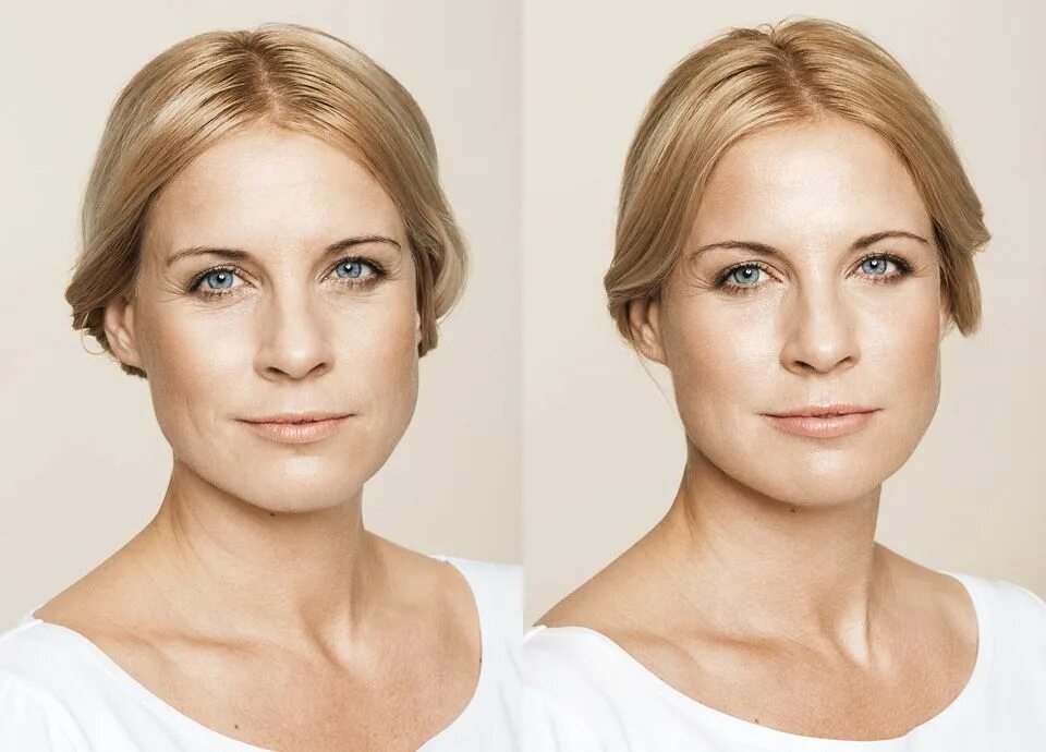 O Que é Skinboosters? Beleza Cultura Mix