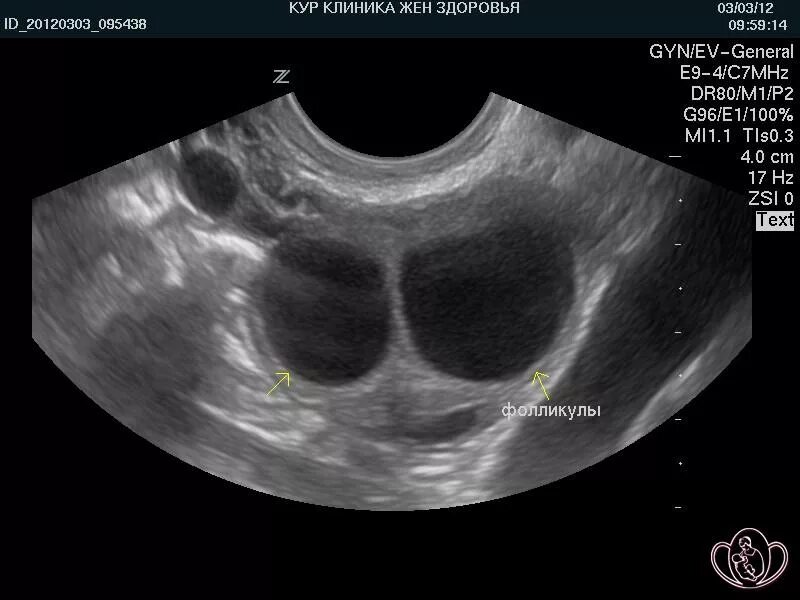 3 5 фолликулов в яичнике. Функциональная киста яичника на УЗИ. Фолликулярная киста яичника на УЗИ. Фолликулярная киста снимки. Медиально киста яичника.