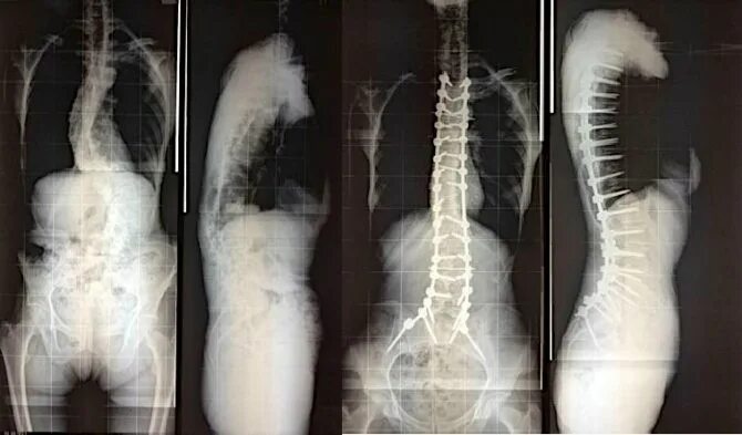 Сколиоз 2 степени рентген. Сколиоз поясничного отдела 2 степени рентген. Сколиоз 1 степени поясничного отдела рентген. Сколиоз позвоночника 3 степени рентген.