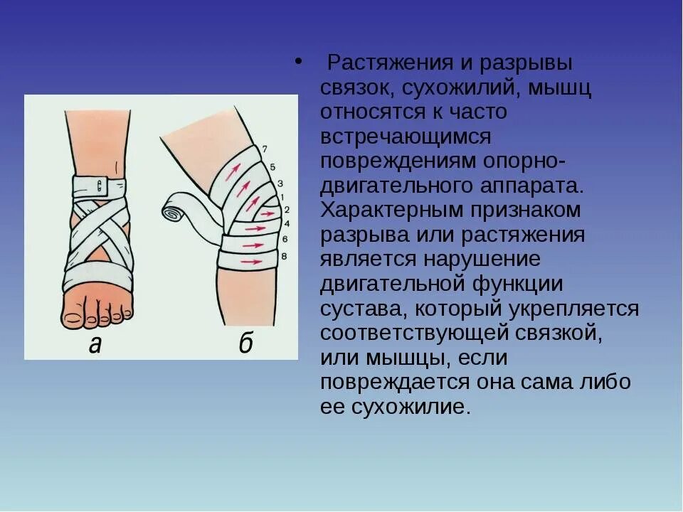 Разрыв и растяжение. Растяжение и разрыв связок. Первая степень растяжения связок.