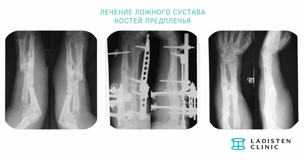 После ложных