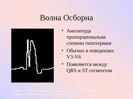 Зубец осборна на экг