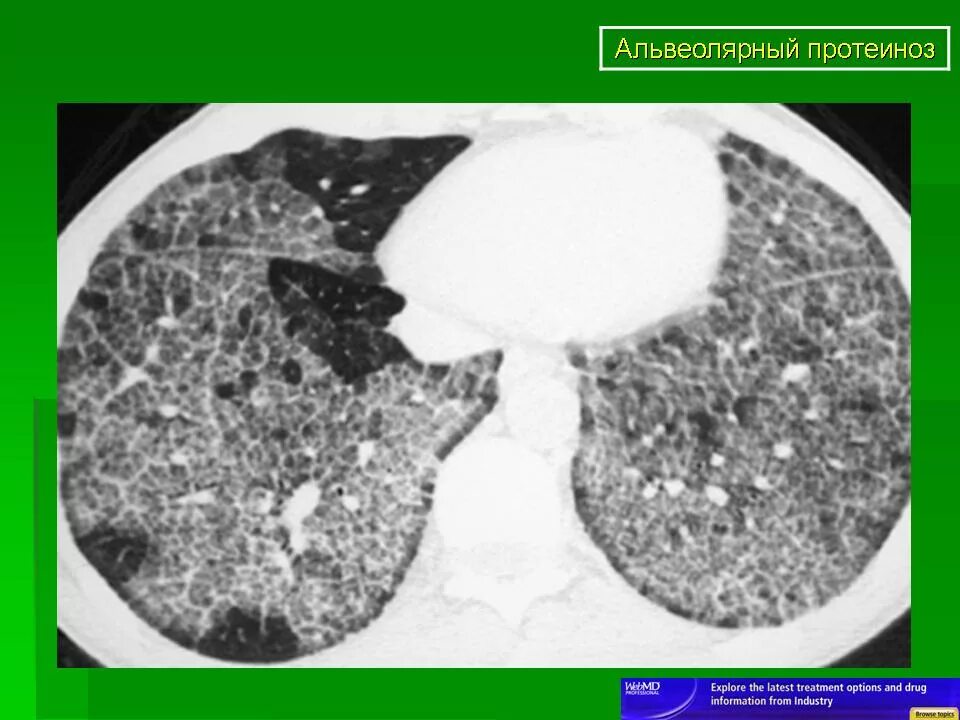 Альвеолярный протеиноз кт. Легочный альвеолярный протеиноз кт. Альвеолярный протеиноз легких на кт. Легочный альвеолярный протеиноз рентген.
