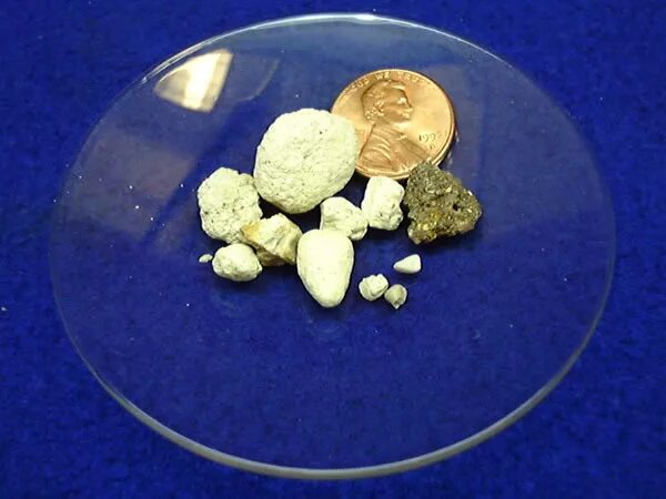 Kidney stones The man did not go to the hospital for a long time due to discomfo