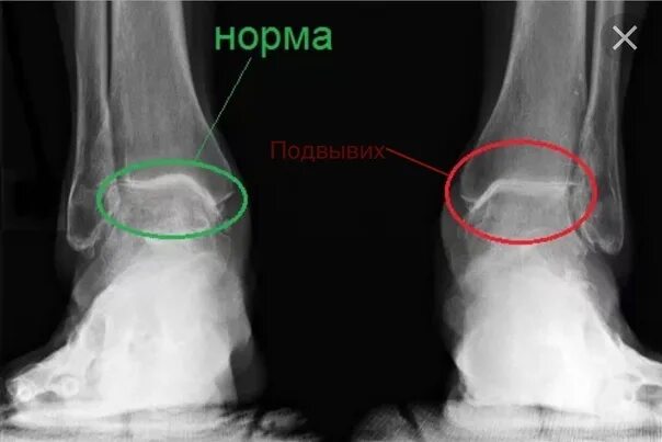 Голеностопный сустав норма. Перелом лодыжки рентген. Доа голеностопного сустава рентген. Артроз таранно-пяточного сустава рентген. Чрезсиндесмозный перелом наружной лодыжки.