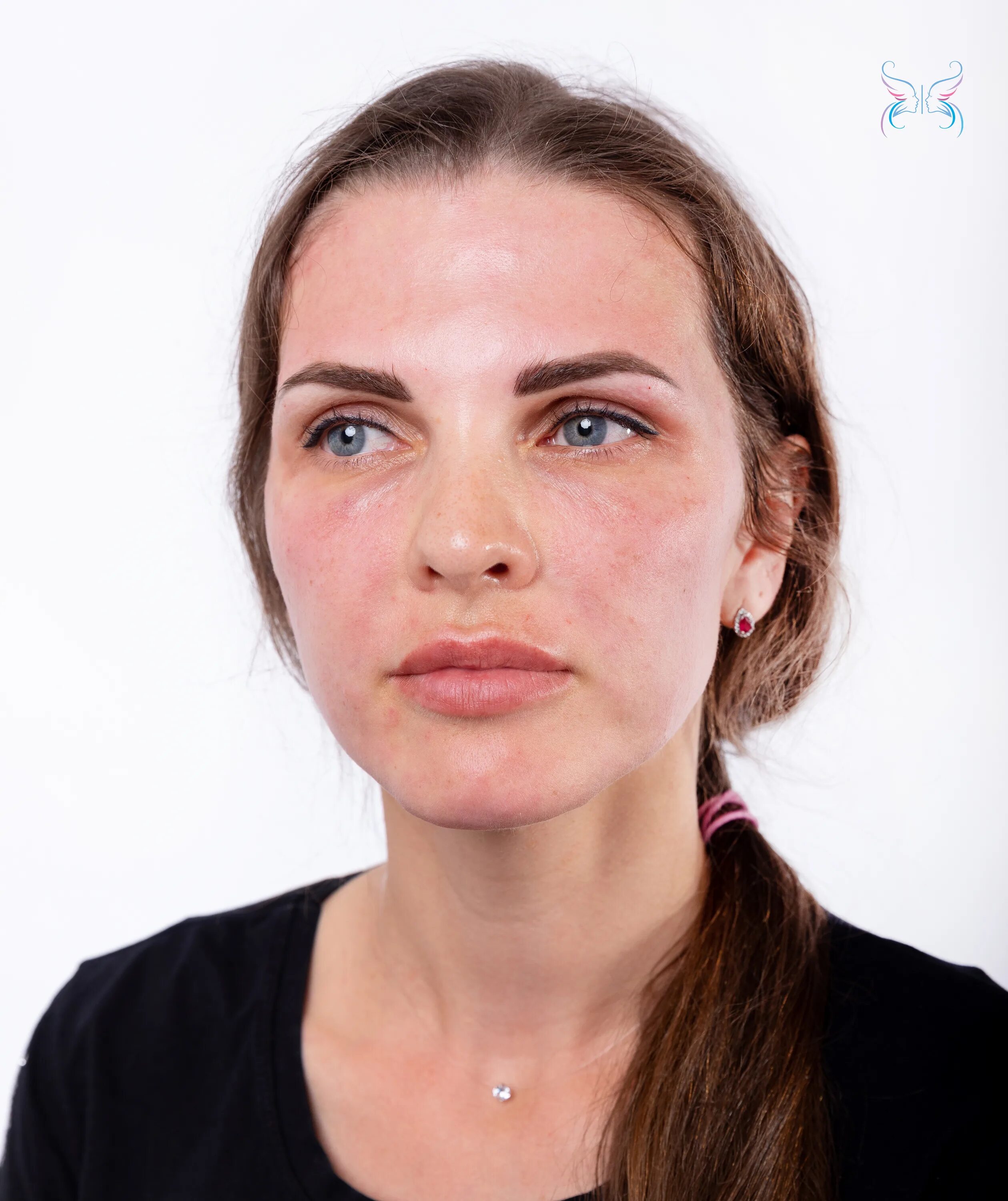 Плазмолифтинг cortexil. Cortexil prp плазмотерапия. cortexil prp плазмотерапия лица. центрифуга cortexil prp.