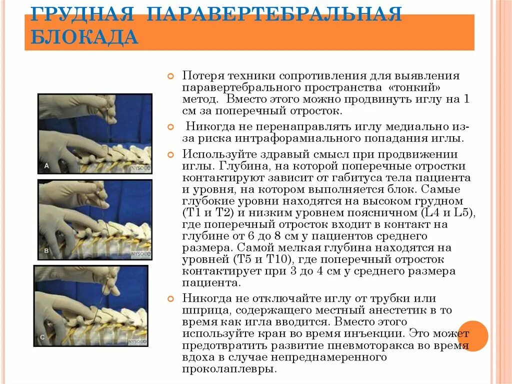 Блокада техника выполнения. Техника проведения паравертебральной блокады. Техника выполнения паравертебральной блокады. Паравертебральная новокаиновая блокада. Паравертебральной новокаиновой блокад..