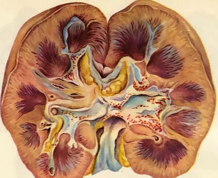 Острая почечная недостаточность патанатомия. Некротический нефроз с острой почечной недостаточностью. Умеренные диффузные почек