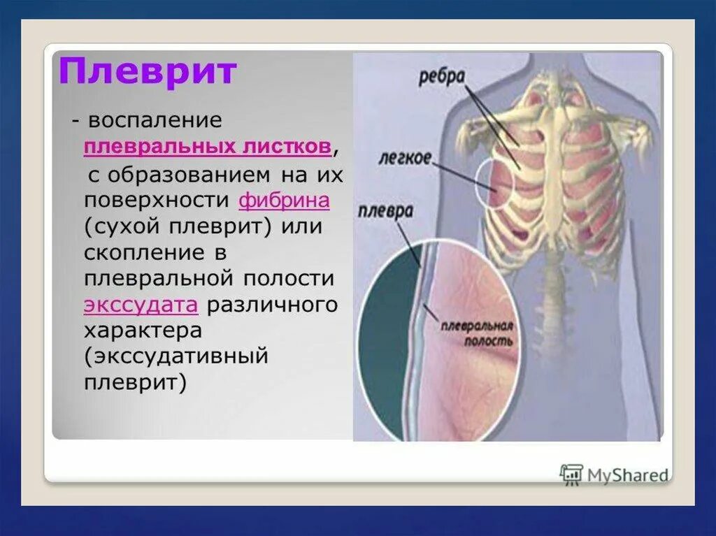 Боли в ребрах легкие. Воспаление листков плевры. Алеврит. Воспаление плевры легких.