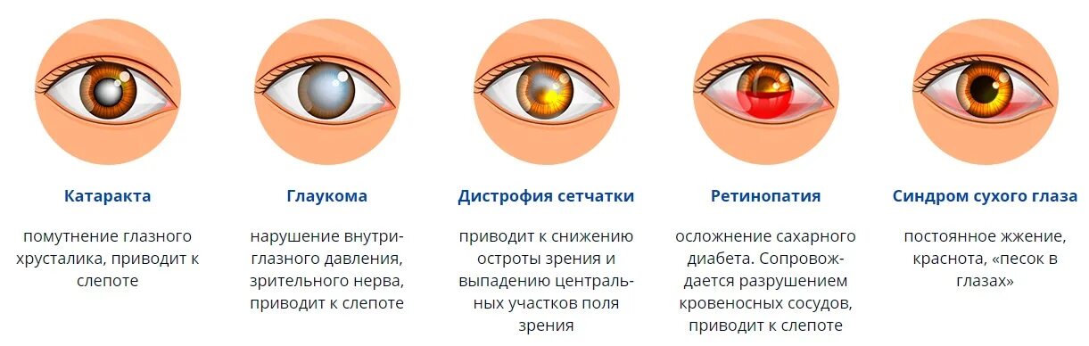 Болит глаз плохо видит. Глазные болезни катаракта таблица. Катаракта схема глаза. Катаракта глаза причины возникновения симптомы. Глаукома катаракта конъюнктивит.