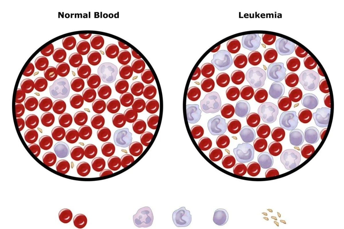 Онкозаболевания крови. Лейкоз клетки крови. Лейкоз и нормальная кровь.