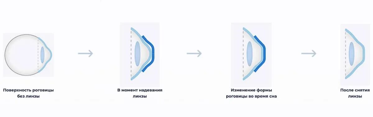 Ночные ортокератологические линзы. Ортокератология (ночные контактные линзы). Принцип работы ночных линз. Линзы ночные для коррекции зрения для детей. Сколько стоит ночные линзы для восстановления зрения