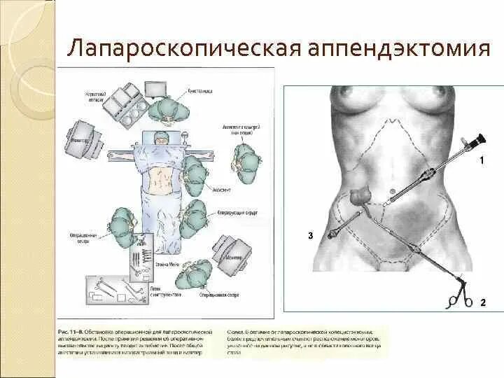 Что можно ребенку после аппендицита. Аппендэктомия лапароскопия доступы. Лапароскопическая аппендэктомия этапы операции. Точки троакаров при лапароскопической аппендэктомии. Аппендэктомия дренирование брюшной полости.